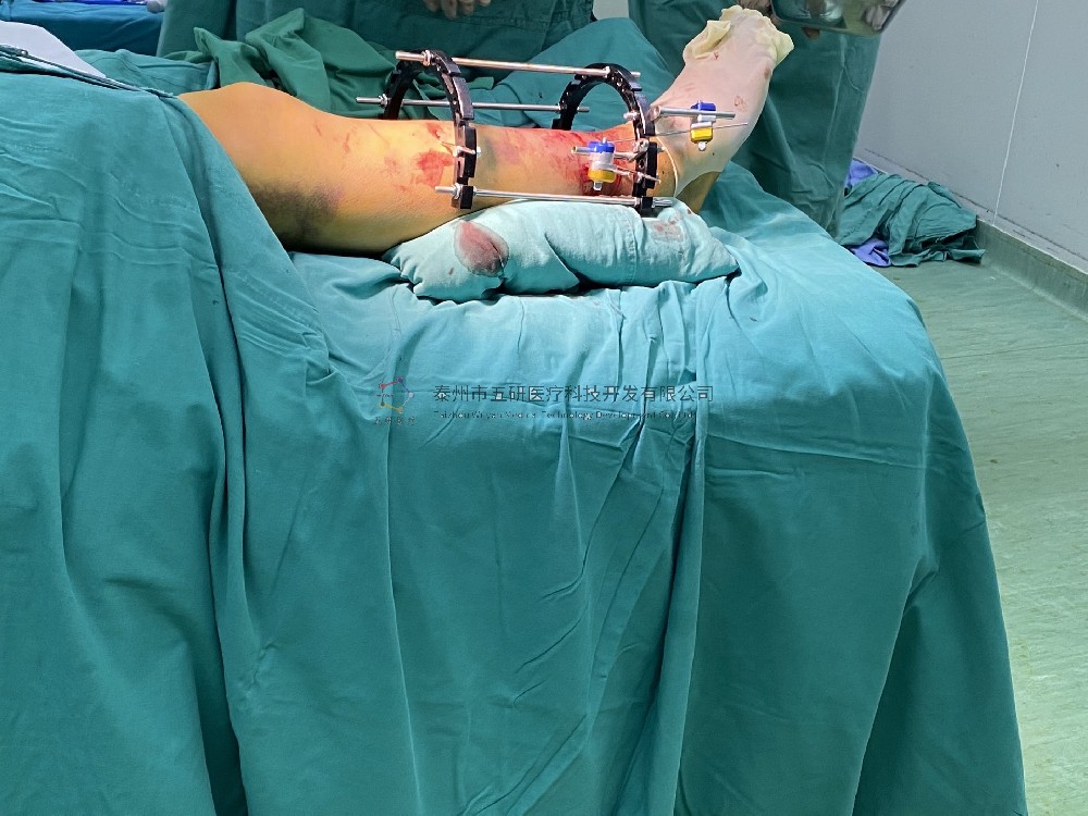 【望京醫院】不開刀治骨折病例分享——下肢骨折